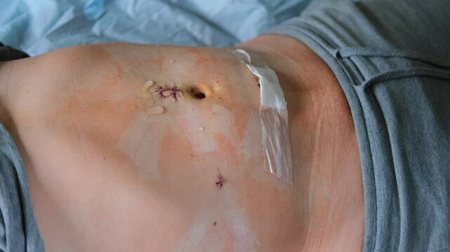 Hands of medic or nurse in blue gloves examining a fresh suture on a male stomach after laparoscopy surgical removal of appendicitis. Doctor examines of the patient. Man belly with medical stitches