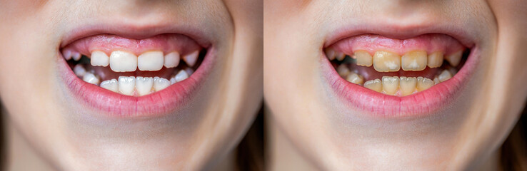Child teeth before and after. Child shows teeth with stains and plaque close-up. Children...