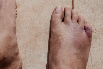 Fractured little pinky toe finger in a right foot bruised