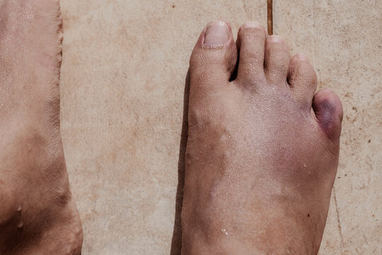 Fractured little pinky toe finger in a right foot bruised