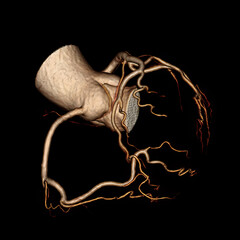 CT image of a heart coronary tree isolated on black