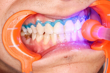 A blue gel applied on the neck of the upper teeth to protect the gingival gum from dental bleaching process. An orange cheek retractor keeps mouth open in biting occlusion while applying a blue light.