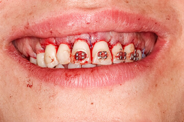 Gummy smile correction surgical clinical case. Third surgery step: gum suturing after bone defect correction and gingival repositioning with the right alignment in upper position. © MSC