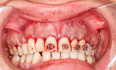 Gummy smile correction surgical clinical case. Third surgery step: gum suturing after bone defect correction and gingival repositioning with the right alignment in upper position. © MSC