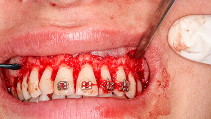 Fototapeta premium Gummy smile clinical case with orthodontic brackets. Second surgery step: gingival retraction with dental strippers instruments. Surgical detachment, exposing the alveolar bone and contour reshaping. 