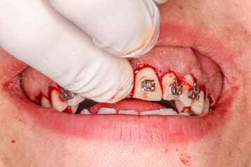Gummy smile clinical case with orthodontic brackets. First surgery step: gingival incision for surgical detachment bleeding gums. Mouth open with doctor's medical protective gloves finger on. © MSC