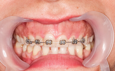 Obraz premium Gummy smile clinical case with orthodontic brackets and metallic wire. Patient has cheeks and lips retracted with a cheek retractor, showing uneven gum line before gum contouring surgery