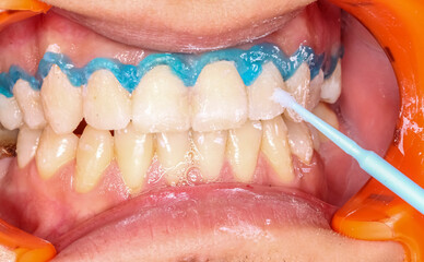 A blue gel applied in arcs on the neck of the maxillary teeth to protect the gingival gum from the agressif dental bleaching process applied with a brush. An orange cheek retractor keeps mouth open © MSC