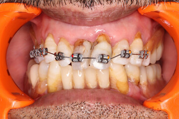Obraz premium Dental case showing orthodontic braces with grey elastic O-ring ligatures and metallic arch wire. Gingivitis and gingival recession present. Cheeks and lips retracted with an orange cheek retractor.