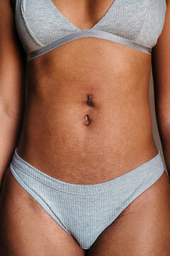 Woman's abdomen with hernia scar on belly