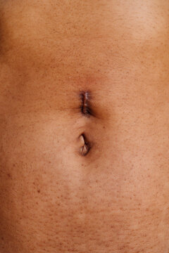 Abdomen with hernia scar on belly
