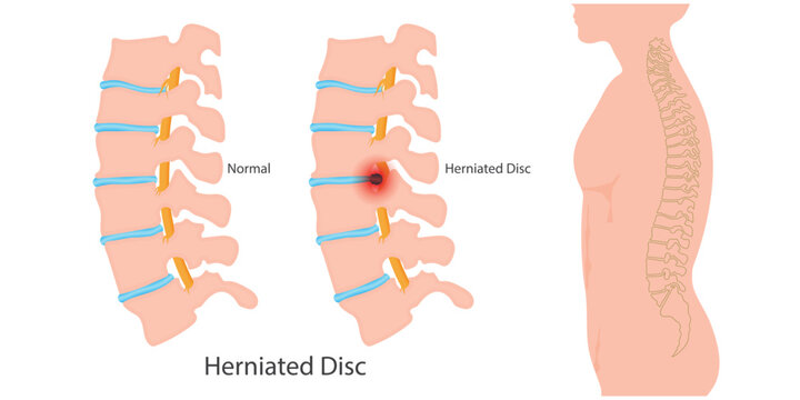 Herniated disc is also known as a slipped.