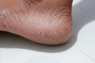 Cracked heel. Skin problems caused by dryness and poor circulation