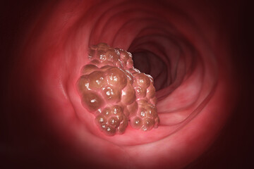 Esophageal cancer in a human stomach. 3d rendering