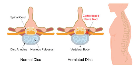 A slipped disc occurs when the outer covering of the disc tears.