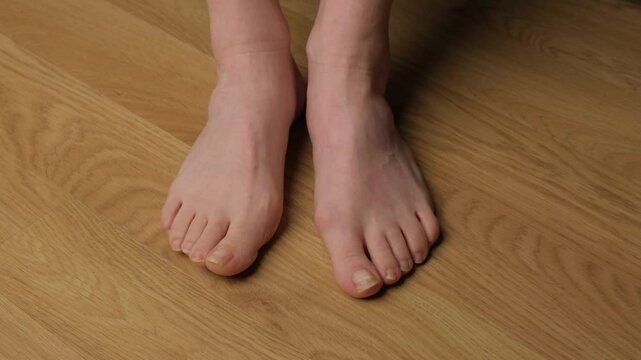 Close-up of a woman's feet with hallux valgus.