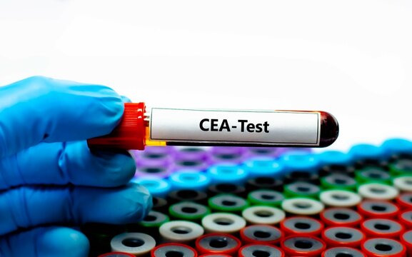 Blood sample tube for carcinoembryonic antigen (CEA) test analysis.