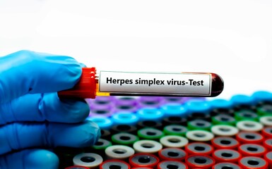 Blood sample tube for herpes simplex virus (HSV) test analysis.