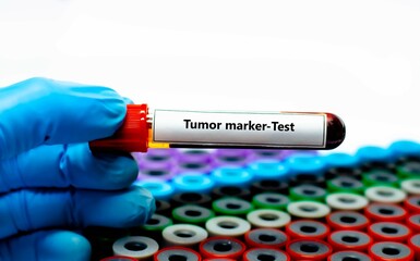 Blood sample tube for tumor marker test analysis.