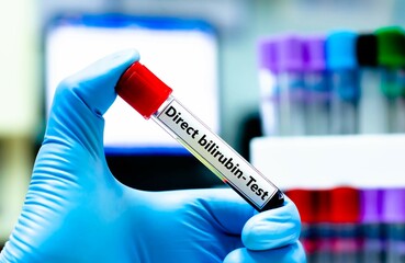 Fototapeta premium Blood sample tube for direct bilirubin test analysis.