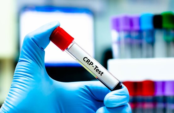 Blood sample tube for C-reactive protein (CRP) test analysis.