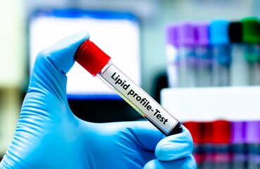 Blood sample tube for lipid profile test analysis. © kitsawet