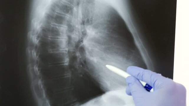 Doctor radiologically analyzing the chest with x-ray
profile.hand of a doctor analyzing and pointing with a pen to the affected area