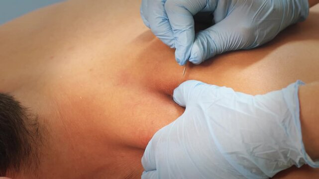 Physiotherapy Clinic: Dry Needling