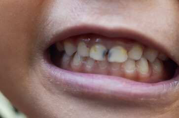 The image shows a child with severe tooth decay, characterized by discoloration and cavities.