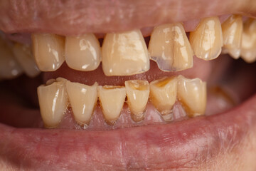 Attrition tooth due to interaction with other teeth in elderly woman.