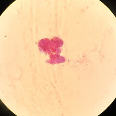 Bladder cancer cells