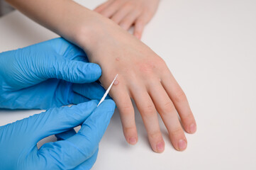 Fototapeta premium Child undergoing treatment for warts. Doctor removing wart from hand with applicator with medical solution, close-up. Papillomavirus, HPV. Pediatric dermatology, viral skin diseases