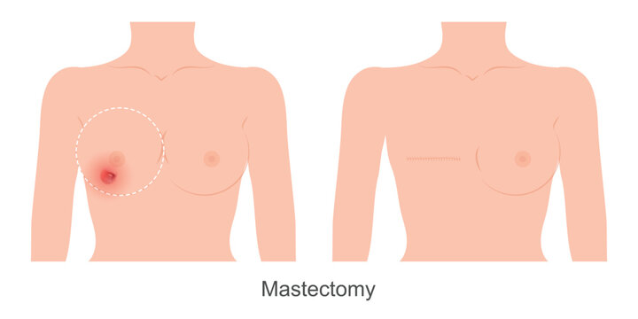 Mastectomy is a way of treating breast cancer.