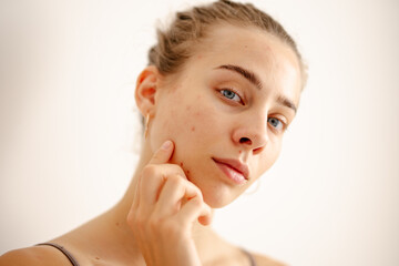 A woman touches her face gently while inspecting her skin for acne and imperfections. Pimples. Acne...