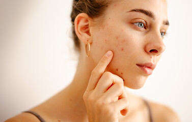 A woman touches her face gently while inspecting her skin for acne and imperfections. Pimples. Acne...