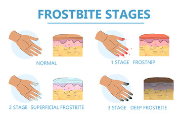 Frostbite stages infographic vector isolated. Damaged fingers. Signs of hypothermia. Concept of health care, symptoms of frostbite.