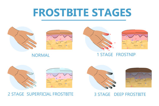 Frostbite stages infographic vector isolated. Damaged fingers. Signs of hypothermia. Concept of health care, symptoms of frostbite.