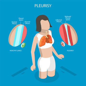 3D Isometric Flat Vector Illustration of Pleurisy Or Pleuritis Disease, Medical Overview of Lung Inflammation