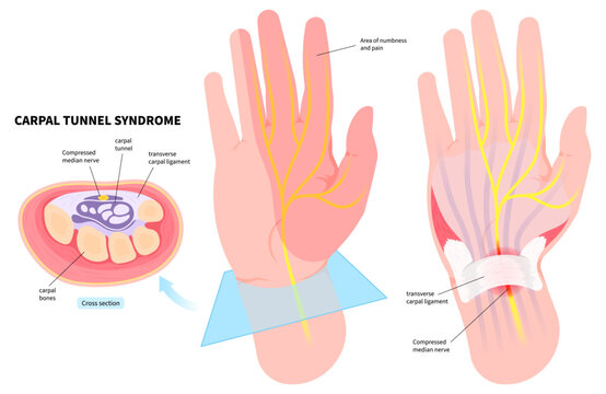 Hand pain numbness associated with the Quervain's tenosynovitis disease and Carpal tunnel syndrome in medical