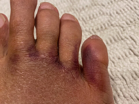 Little toe finger fractured and bruised foot