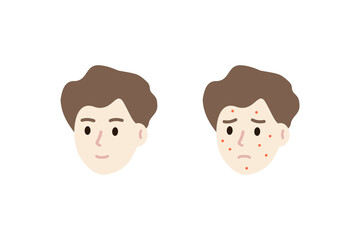 Set of happy and sad man face head with red rash pimple. Boy with skin problem. Beauty, skincare, treatment, hygiene, allergy concepts.  Flat vector people character design isolated illustration.
