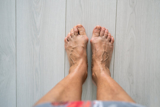 Valgus hallux deformity. Elderly woman varicose bare feet with growth. Aged female tolerate distress, fatigue post pedestrian activity due to foot excrescence, pain, inflammation, orthopaedics need