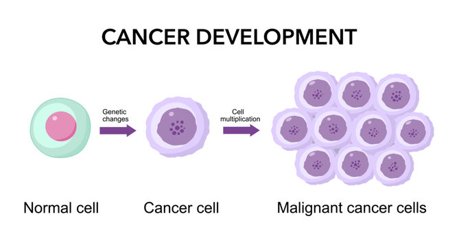 Cancer development. Normal cells are transformed into cancer. Carcinogenesis from Genetic mutations in healthy cell to Malignant cancer cells.