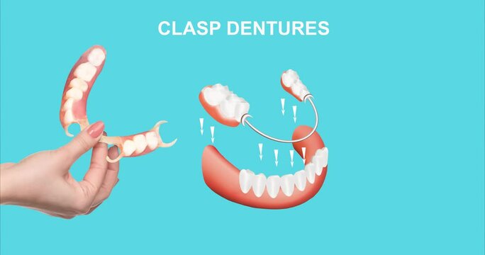 Dental rehabilitation with lower flexible nylon denture, before and after treatment. Removable dentures flexible, devoid of nylon, hypoallergenic exempt from monomer - 2D animation.