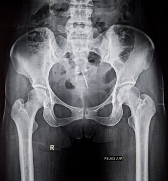 X ray pelvis shows Intra Uterine Contraceptive device, IUCD or Copper T in the uterus 