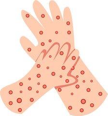 Hand with Monkeypox Virus