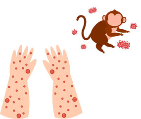 Kid Having Monkeypox Virus