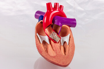 Cardiac model of Transcatheter aortic valve implantation (TAVI) for people education. Heart...