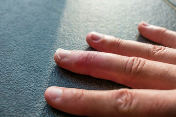 Mallet finger healing after splint removal from middle finger following joint trauma