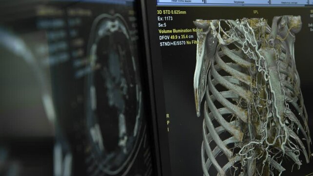 Computed tomography CT to diagnose and determine the stage of cancer.